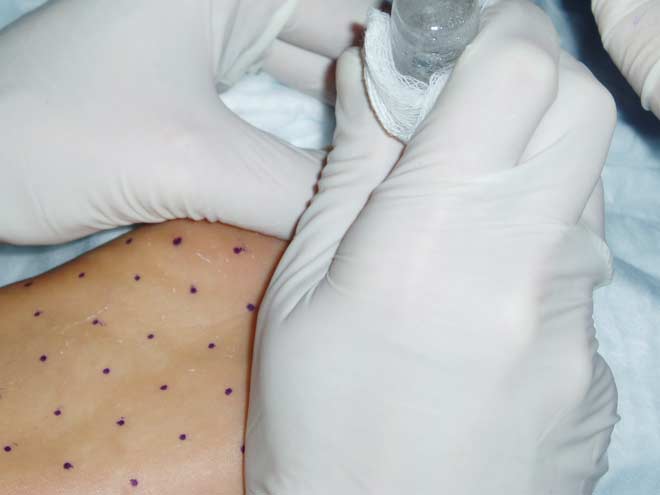 Botox being injected into feet